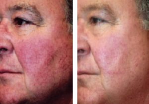 laser-pigmentation