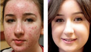 Acne B & A