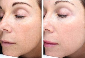 Skin Resurfacing