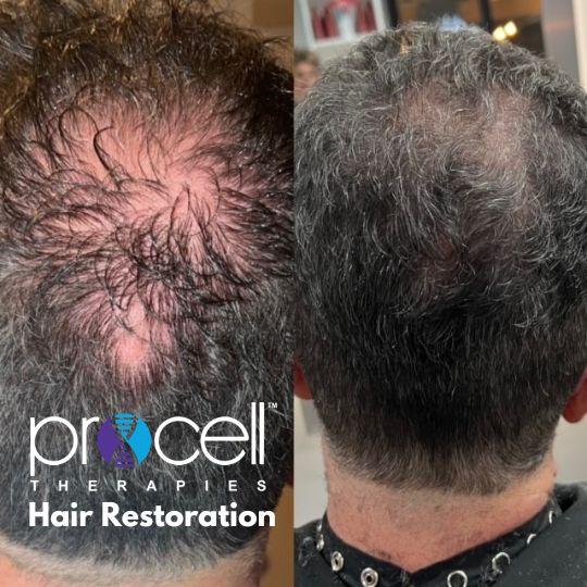 Procell Hair Restoration